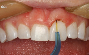 Color textbooks and coloration visualization Dental Economics picture relating to Tooth Shade Chart Printable titled Colour textbooks and shade visualization Dental Economics